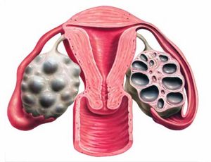Мультифолликулярные яичники: структура, лечение, беременность