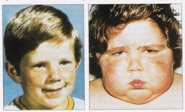 Синдром Иценко Кушинга: фото до и после