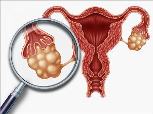Причины дисфункции яичников, последствия для организма женщины, и методы лечения заболевания
