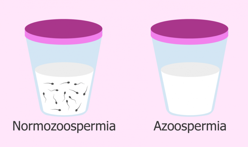 Что значит диагноз азооспермия?