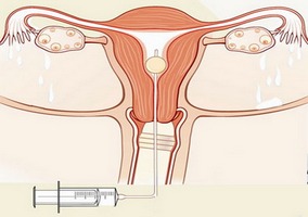 Может ли эхогистеросальпингоскопия выявить причину женского бесплодия?