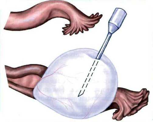 Кульдоцентез при кисте яичников: влияние на будущую беременность
