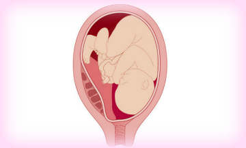 Чего ожидать при беременности и родах с низкой плацентацией