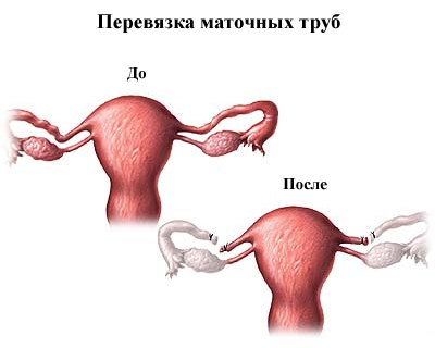 перевязка труб у женщин последствия для здоровья